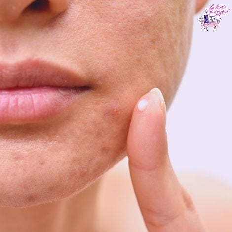 Peaux acnéiques : pourquoi la skincare coréenne est une solution efficace ?