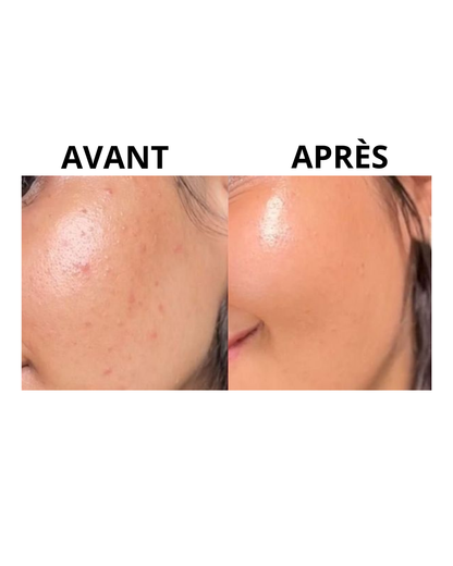 BOX ACNE CLEAR ROUTINE   PRIX MINI- Skincare Coréenne ANTI-ACNÉ- ⭐ BEST SELLER